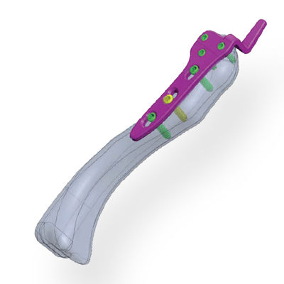 Placca per osteotomia per rticolazione acromioclavicolare - Invamed - prossimale / bloccata / in metallo