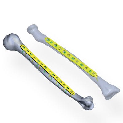 Placca di compressione per radio - Invamed - per ulna / per omero / mediale