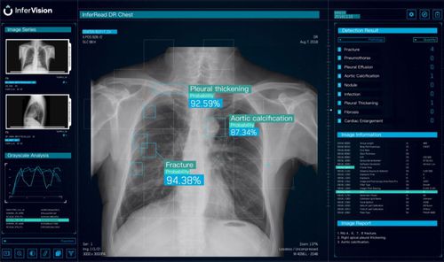 Software di analisi - DR Chest - Beijing Infervision Technology Co. Ltd. - di visualizzazione / per reportistica / medico