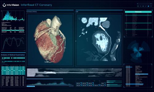 Software medico - InferRead® - Beijing Infervision Technology Co. Ltd. - per tomografia computerizzata / di analisi / di gestione dati