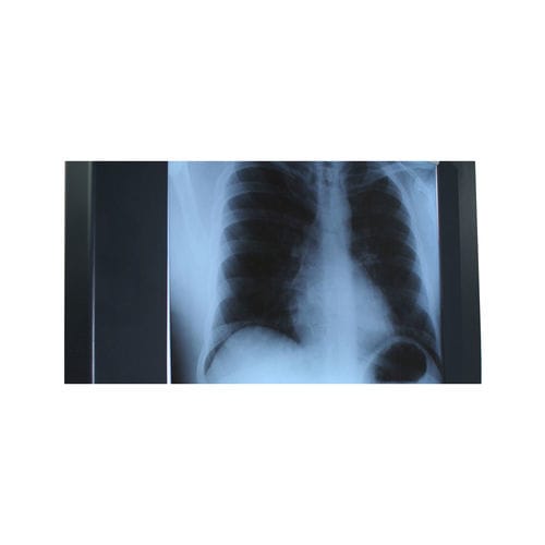 Negativoscopio 1 corpo - Woodmans Meditech - LED