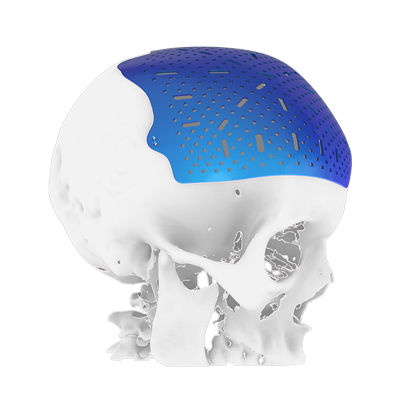Impianto cranico su misura - Osteophoenix