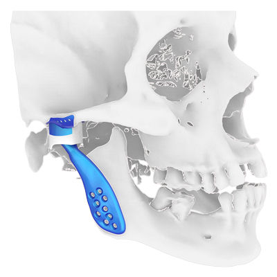 Impianto temporo-mandibolare su misura - Osteophoenix