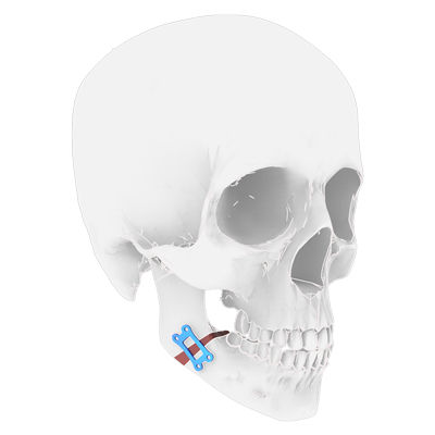 Placca per osteotomia per mandibola - Osteophoenix - in titanio