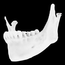 Modello anatomico osseo - Osteophoenix - mandibolare / per chirurgia odontoiatrica