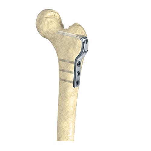 Placca per osteotomia per femore - Wuxi Betta Medical Technology - prossimale / bloccata / in metallo