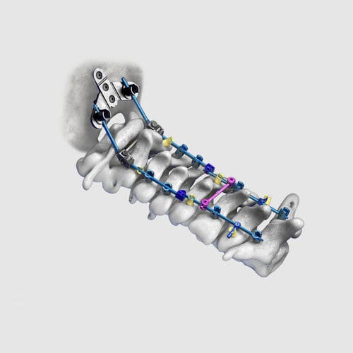 Sistema di osteosintesi occipitocervicale - Wuxi Betta Medical Technology - via posteriore / per adulti