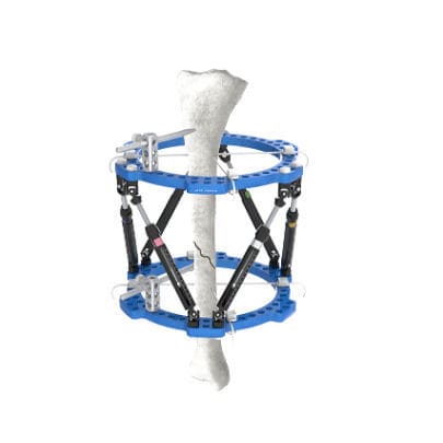 Fissatore esterno per tibia - Wuxi Betta Medical Technology - per caviglia / circolare / per adulti