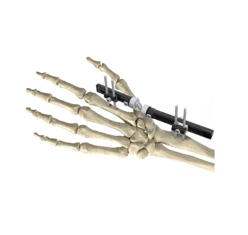 Fissatore esterno per polso - Wuxi Betta Medical Technology - per omero / per radio / per ulna
