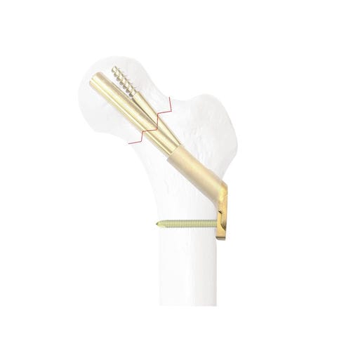 Placca di compressione per testa del femore - 33506  - Kangli Medical - bloccata / in titanio