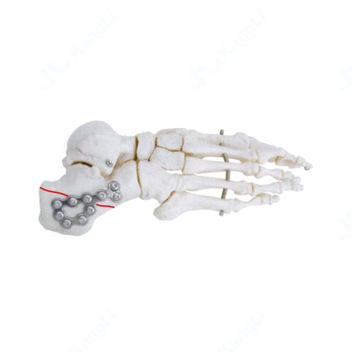 Placca di compressione per calcagno - T3010 - Kangli Medical - non bloccata / in titanio