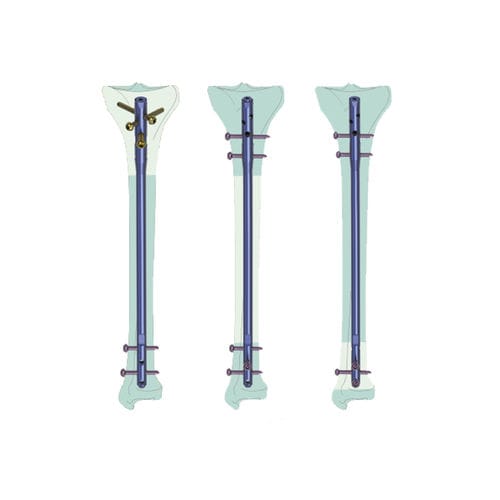Chiodo intramidollare per tibia - KTO  - Kangli Medical - fissazione prossimale / fissazione distale / in titanio
