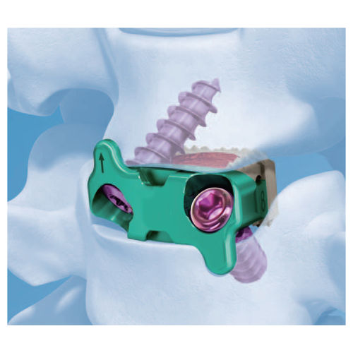 Gabbia intersomatica cervicale - G-58020 - Kangli Medical - via anteriore / in PEEK
