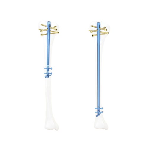 Chiodo intramidollare per tibia - QML - Kangli Medical - in titanio