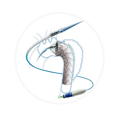 Innesto stent per aorta toracica ascendente - Hercules™ - Endovastec - in nitinol / in polietilene