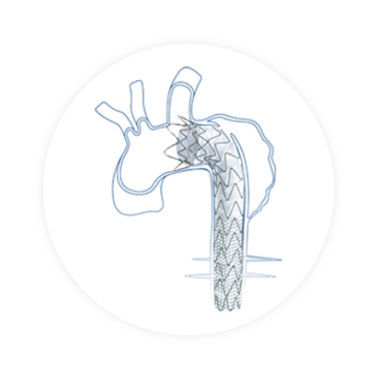 Innesto stent per aorta toracica ascendente - Talos™ - Endovastec - in nitinol