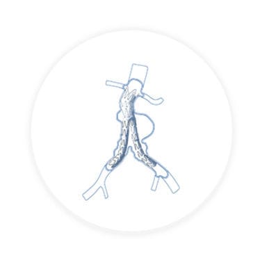 Innesto stent arteria iliaca - Hercules™ - Endovastec - in nitinol / in polietilene