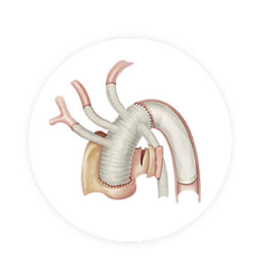 Innesto stent per arco aortico - CRONUS™ - Endovastec - in cobalto-cromo / in polietilene