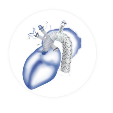 Innesto stent per arco aortico - Fontus™ - Endovastec - in nitinol / in polietilene