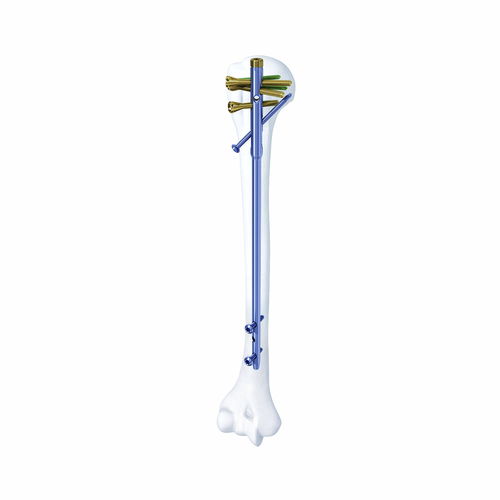Chiodo intramidollare per omero - SHGK - Chongqing FWS Medical Device - fissazione prossimale / fissazione diafisaria / in metallo