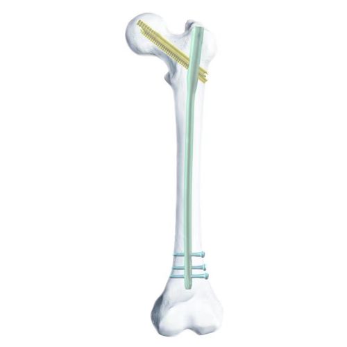 Chiodo intramidollare per femore - SGG - Chongqing FWS Medical Device - in titanio
