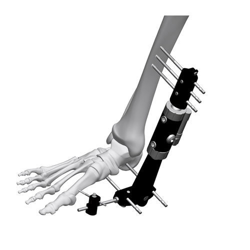 Fissatore esterno per caviglia - FE8M-D050   - Chongqing FWS Medical Device - tubolare / per adulti
