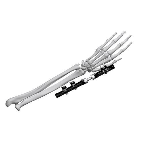 Fissatore esterno per polso - FE5M-D030  - Chongqing FWS Medical Device - tubolare / per adulti