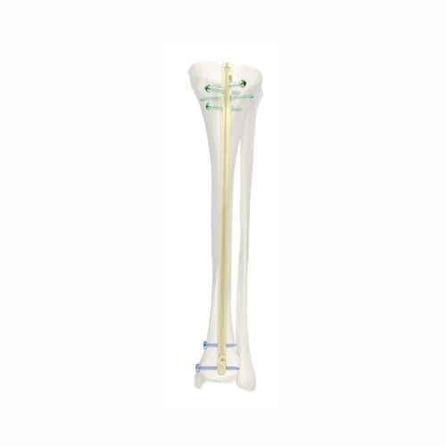 chiodo intramidollare per tibia - Chongqing FWS Medical Device