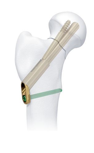 Chiodo intramidollare per femore - GJD-P - Chongqing FWS Medical Device - in titanio