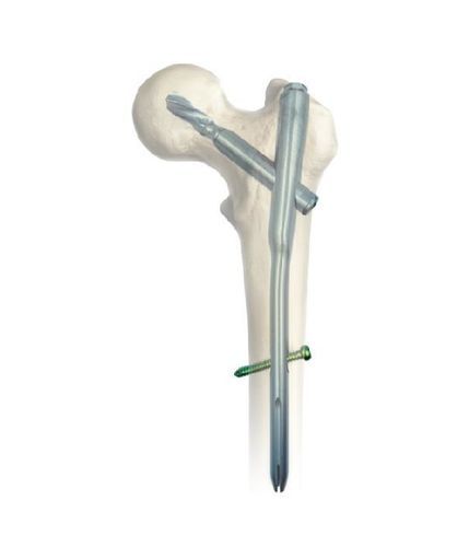 Chiodo intramidollare per femore - SGM - Chongqing FWS Medical Device - fissazione prossimale / in titanio
