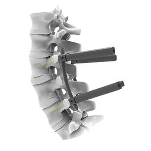 Sistema di osteosintesi lombare - CTS 5.5 MIS - Mediox - via posteriore / per adulti