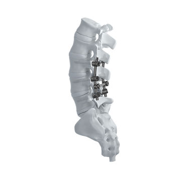 Sistema di osteosintesi lombare - CTS 5.5 - Mediox - via posteriore / per adulti