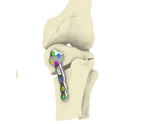 Placca per osteotomia per tibia - TOKA - Orthoscape - bloccata / in metallo