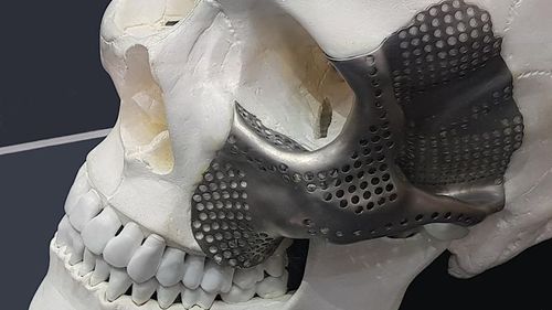 Impianto periorbitale su misura - OrthoCMF - Orthoscape - non assorbibile