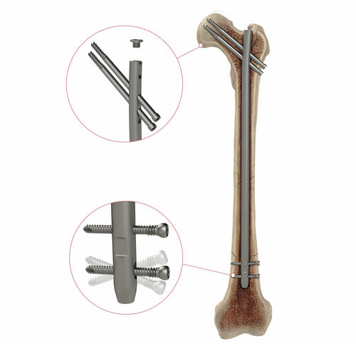 Chiodo intramidollare per femore - AS.AFN.400 - Ases Orthopedics - fissazione prossimale / fissazione distale / destro