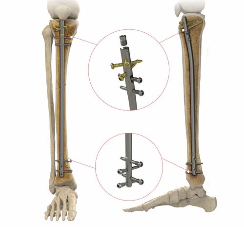 Chiodo intramidollare per tibia - AS.ATN.401 - Ases Orthopedics - fissazione prossimale / fissazione distale / in titanio