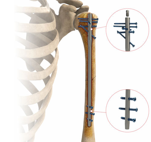 Chiodo intramidollare per omero - AS.HUM.402 - Ases Orthopedics - fissazione diafisaria / fissazione prossimale / destro
