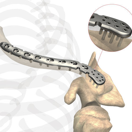 Placca di compressione per clavicola - AS.SH.029 - Ases Orthopedics - distale / bloccata / non bloccata