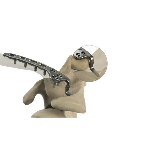 Placca di compressione per clavicola - AS.SH.031 - Ases Orthopedics - distale / bloccata / non bloccata