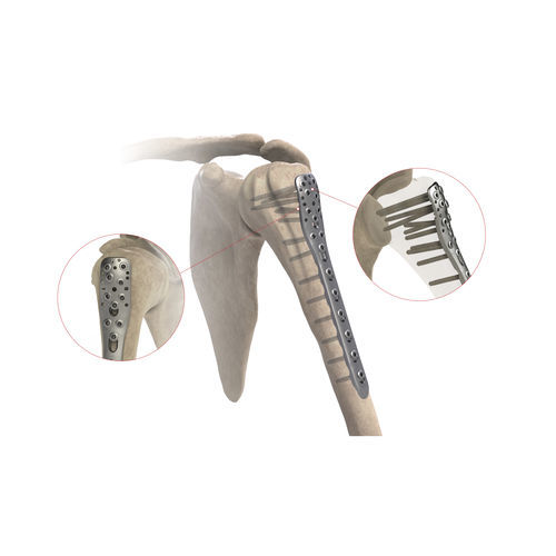Placca di compressione per omero - AS.SH.026 - Ases Orthopedics - prossimale / laterale / bloccata