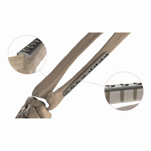 Placca di compressione per radio - AS.ST.064 - Ases Orthopedics - per ulna / mediale / non bloccata