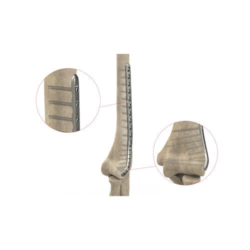 Placca di compressione per omero - AS.E.021 - Ases Orthopedics - distale / laterale / bloccata