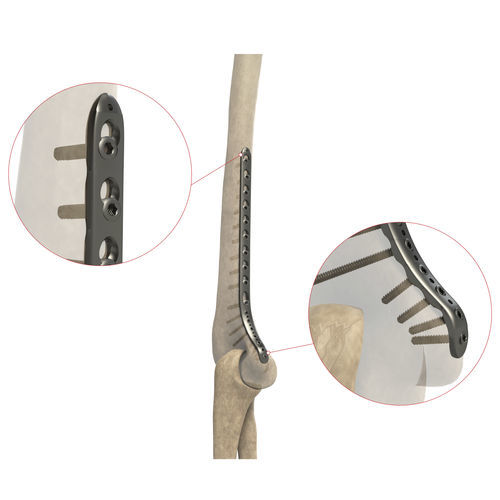 Placca di compressione per omero - AS.E.020 - Ases Orthopedics - distale / mediale / bloccata