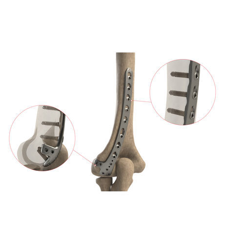 Placca di compressione per omero - AS.E.022 - Ases Orthopedics - distale / posterolaterale / bloccata