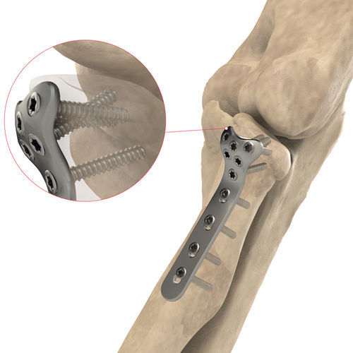 Placca di compressione per capo radiale - AS.E.019 - Ases Orthopedics - prossimale / bloccata / in titanio