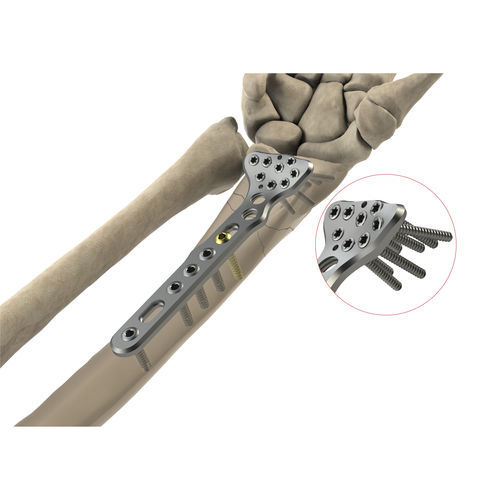 Placca di compressione per radio - AS.W.011 - Ases Orthopedics - distale / bloccata / non bloccata