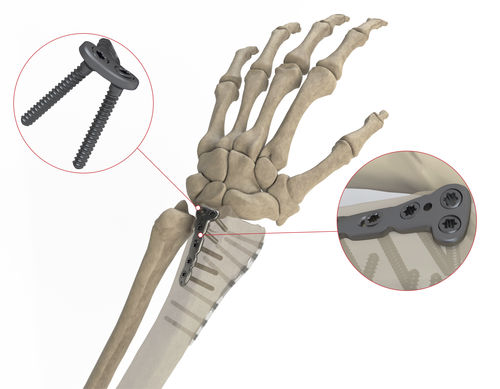 Placca di compressione per radio - AS.W.014 - Ases Orthopedics - distale / dorsale / bloccata