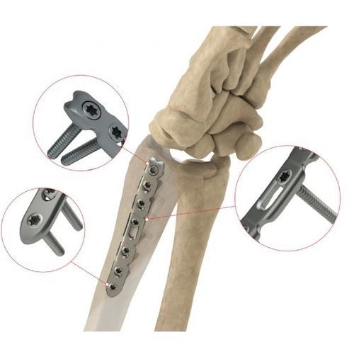 Placca di compressione per radio - AS.W.015 - Ases Orthopedics - distale / laterale / bloccata