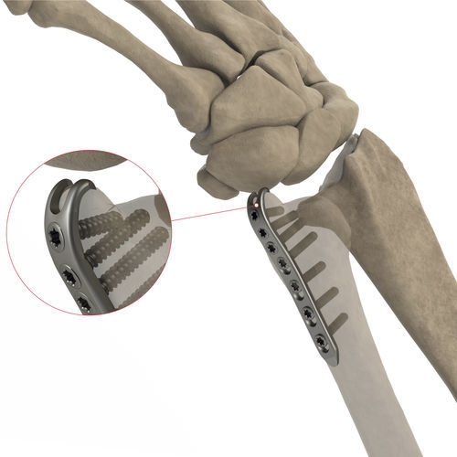 Placca di compressione per ulna - AS.W.016 - Ases Orthopedics - distale / bloccata / non bloccata