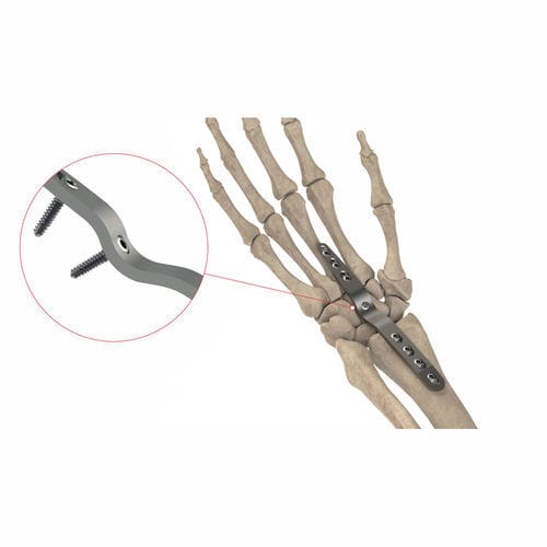 Placca per artrodesi per polso - AS.W.074 - Ases Orthopedics - dorsale / bloccata / non bloccata